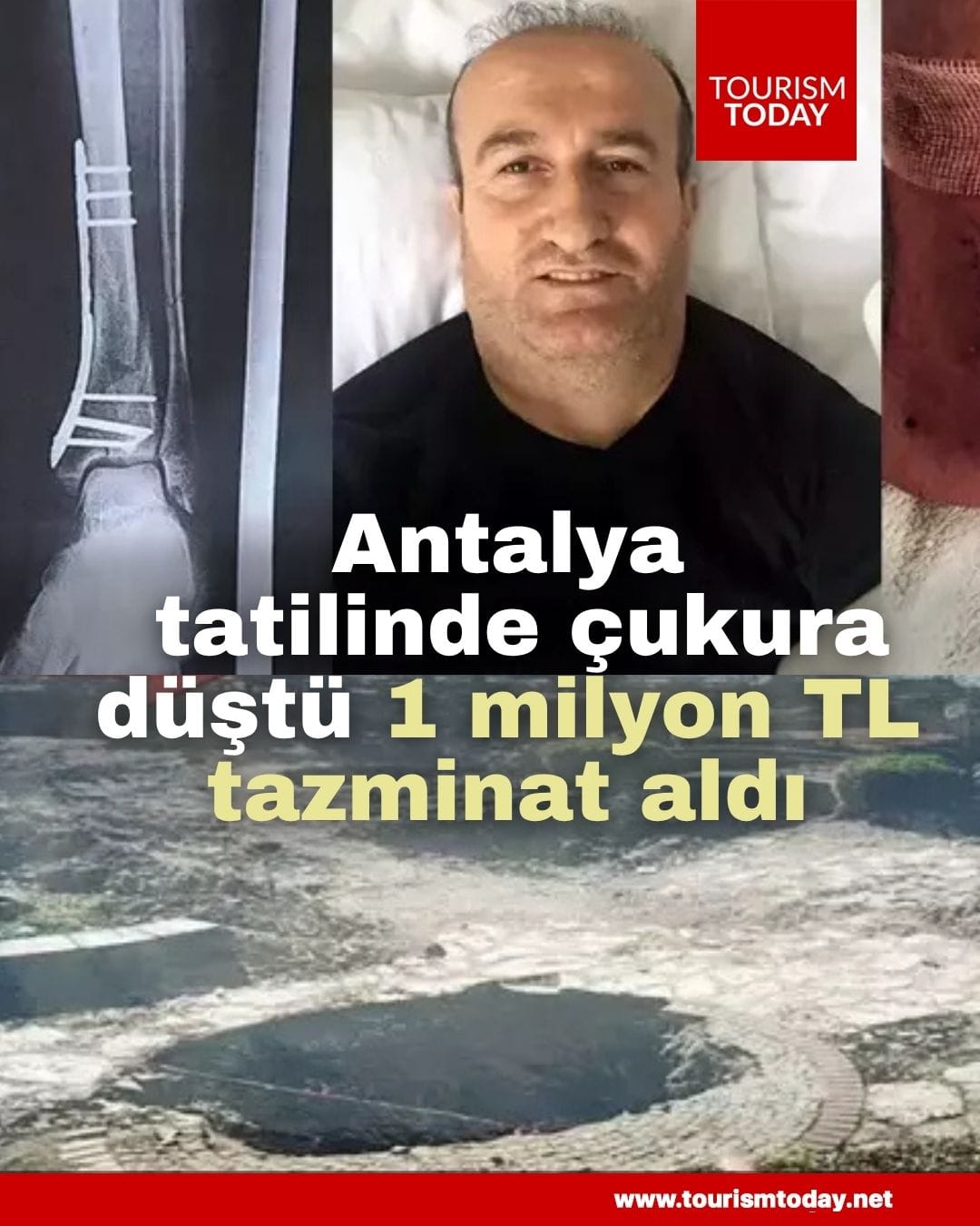 Antalya tatilinde çukura düştü 1 milyon TL tazminat aldı